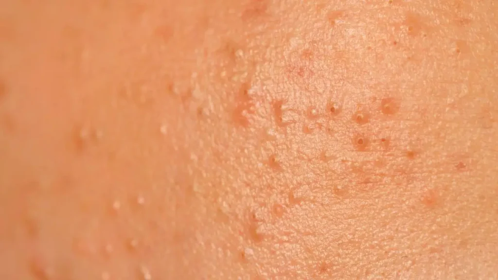Comedonal Acne Comedones Guide Causes And Treatments Comedonal Acne Comedones Guide Causes And Treatments